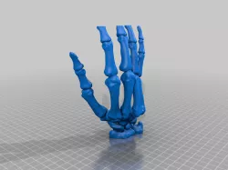 Hand bone. Dislocation 4 and 5 metacarpal joint