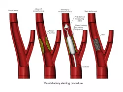 3d printable Carotid artery stenting procedure diorama