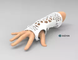 ARM SPLINT - ARM CAST - ARM PLASTER - MEDICAL