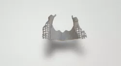 Dental UpperJaw partialframework