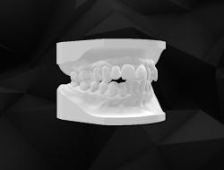 open bite model | Page 1 | STLFinder