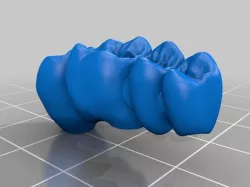 dental bridges on implants