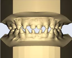 dental model child sharp teeth