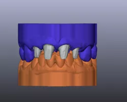 Dental Models DIES and HINGE articulator B4D
