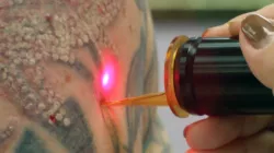 Laser Mac. Protetype