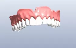 Digital denture  bridged teeth 3D model