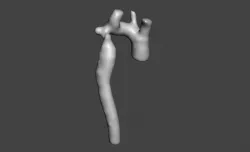 Coarctation of the Aorta