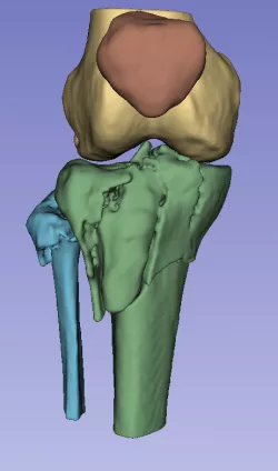 Tibia Fibula Fracture