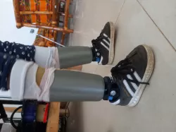 Prosthetic Leg - Fatima