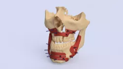 Guiders for jaws osteotomy