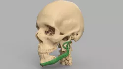 Lower jaw prosthesis