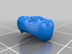 Dental Crown