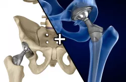 Hip replacement implant installed in the pelvis bone 3D model