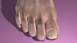 Onchomycosis Nail Fungus 3D model