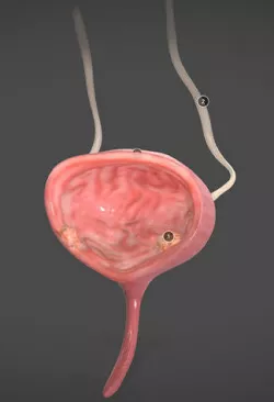 Bladder cancer Low-poly 3D model