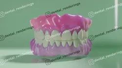 Complete dentures - prostheses 3D model