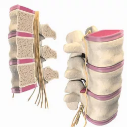 Slipped Bulging Herniated Herniation Disc Spine 3D model