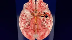 Cerebral aneurysms berry circle of willis 3D model