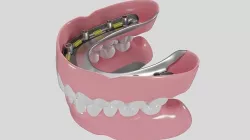 Hibrid implant bar attachment 3D model
