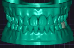 Dental Models and Dental Crown