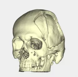 Skull-cranial defect