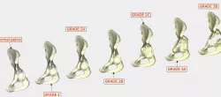 Paprosky Classification of Acetabular Bone Loss