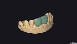 Temporary resin-printed carylae parts 1.1 2.1