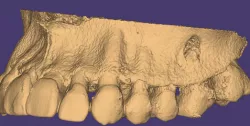 LESIONES APICALES - TEETH PERIAPICAL LESION