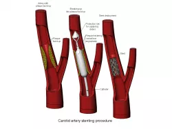 3d printable Carotid artery stenting procedure diorama 3D print model