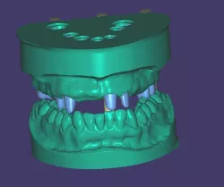 Dental Models with Articulator