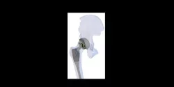 Hip joint replacement