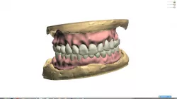 Digital Full Dentures