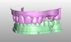 Dental model bridge