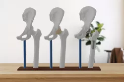 Hip Replacement