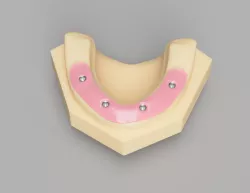 Reference Master Cast with implant analogs