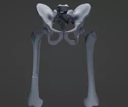 Hip Replacement model