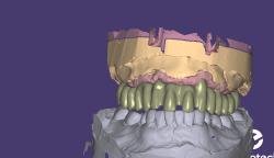 free dental cad cam software download 3D Models | Page 1 | STLFinder