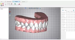 TRANSPARENT ALIGNERS Pac A. 21 dental models or setups of UPPER AND LOWER MAXILLARY "READY FOR 3D PRINTER" - AREA3D - PATIENT A. COMPLETE DENTURE