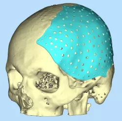 Skull with Cranial Flap