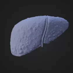 Liver Cirrhosis