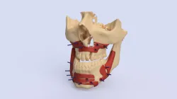 Guiders for jaws osteotomy