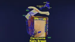 Breast Cancer types spread labelled detail 3D model