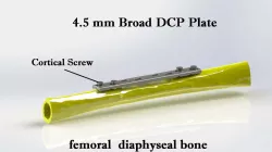 4.5 mm Broad DCP Plate (bone Fixation)