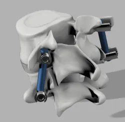 Pedicle Screw System
