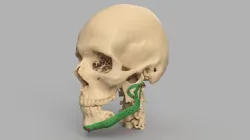 Lower jaw prosthesis