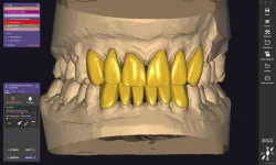 Exocad Galway 3.0 Anterior Crown Project