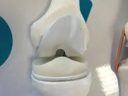 Knee prosthesis model