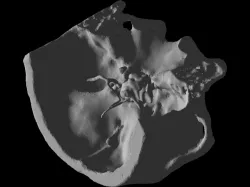Real_PituitaryTumor
