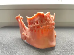 Maxilla and mandible after Bijaw surgery