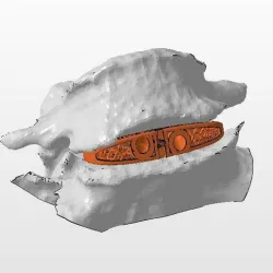 Cage ALIF- Anterior Lumbar Interbody Fusion (real operation)